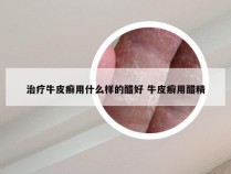治疗牛皮癣用什么样的醋好 牛皮癣用醋精