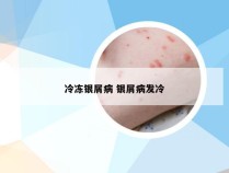 冷冻银屑病 银屑病发冷