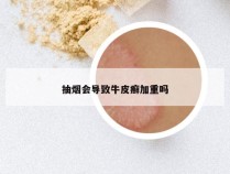 抽烟会导致牛皮癣加重吗