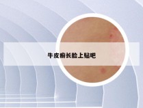 牛皮癣长脸上贴吧