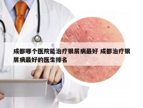 成都哪个医院能治疗银屑病最好 成都治疗银屑病最好的医生排名