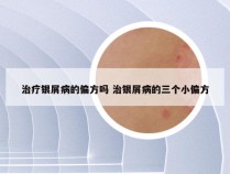 治疗银屑病的偏方吗 治银屑病的三个小偏方