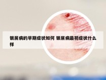 银屑病的早期症状如何 银屑病最初症状什么样