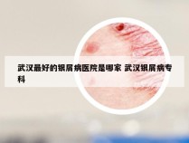 武汉最好的银屑病医院是哪家 武汉银屑病专科