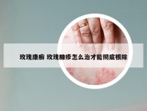 玫瑰康癣 玫瑰糠疹怎么治才能彻底根除