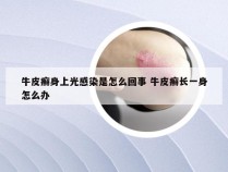 牛皮癣身上光感染是怎么回事 牛皮癣长一身怎么办