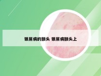 银屑病的额头 银屑病额头上