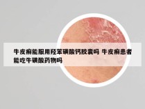 牛皮癣能服用羟苯磺酸钙胶囊吗 牛皮癣患者能吃牛磺酸药物吗