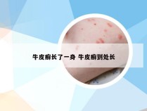 牛皮癣长了一身 牛皮癣到处长