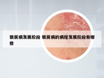 银屑病发展阶段 银屑病的病程发展阶段有哪些