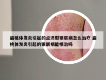 扁桃体发炎引起的点滴型银屑病怎么治疗 扁桃体发炎引起的银屑病能根治吗