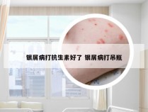 银屑病打抗生素好了 银屑病打吊瓶