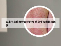 头上牛皮癣为什么好的慢 头上牛皮癣越来越多