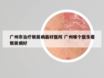 广州市治疗银屑病最好医院 广州哪个医生看银屑病好