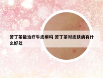 苦丁茶能治疗牛皮癣吗 苦丁茶对皮肤病有什么好处