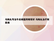 乌梅丸专治牛皮癣医院哪家好 乌梅丸治疗银屑病