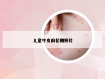 儿童牛皮癣初期照片