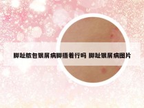 脚趾脓包银屑病脚捂着行吗 脚趾银屑病图片