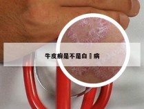 牛皮癣是不是白疕病