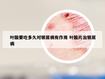 叶酸要吃多久对银屑病有作用 叶酸片治银屑病
