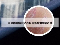 点滴银屑病研究进展 点滴型银屑病过程