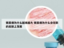 银屑病为什么越来越大 银屑病为什么会往新的皮肤上发展