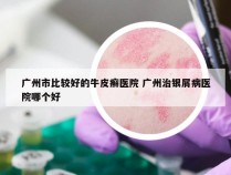 广州市比较好的牛皮癣医院 广州治银屑病医院哪个好