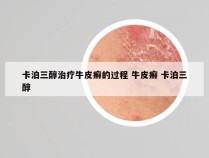 卡泊三醇治疗牛皮癣的过程 牛皮癣 卡泊三醇