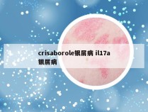 crisaborole银屑病 il17a银屑病