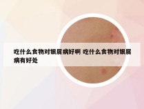 吃什么食物对银屑病好啊 吃什么食物对银屑病有好处
