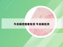 牛皮癣疙瘩里有浓 牛皮癣出浓