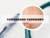 牛皮癣细菌感染症状 牛皮肤癣是细菌吗