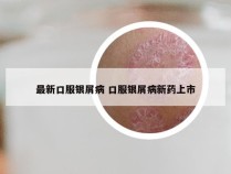 最新口服银屑病 口服银屑病新药上市