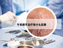 牛皮癣不治疗有什么后果