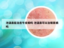 泡温泉能治愈牛皮癣吗 泡温泉可以治银屑病吗