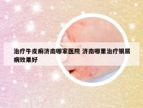 治疗牛皮癣济南哪家医院 济南哪里治疗银屑病效果好