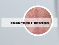 牛皮癣长在肚脐眼上 肚脐长银屑病