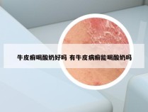 牛皮癣喝酸奶好吗 有牛皮病癣能喝酸奶吗