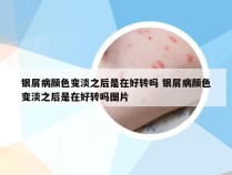 银屑病颜色变淡之后是在好转吗 银屑病颜色变淡之后是在好转吗图片