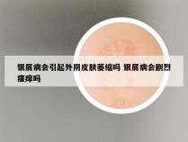银屑病会引起外阴皮肤萎缩吗 银屑病会剧烈瘙痒吗