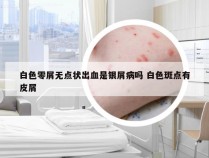 白色零屑无点状出血是银屑病吗 白色斑点有皮屑