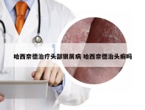 哈西奈德治疗头部银屑病 哈西奈德治头癣吗
