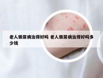 老人银屑病治得好吗 老人银屑病治得好吗多少钱