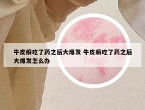 牛皮癣吃了药之后大爆发 牛皮癣吃了药之后大爆发怎么办
