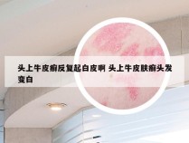 头上牛皮癣反复起白皮啊 头上牛皮肤癣头发变白