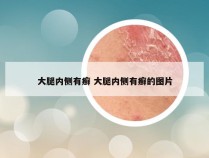 大腿内侧有癣 大腿内侧有癣的图片