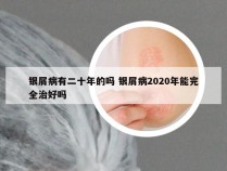 银屑病有二十年的吗 银屑病2020年能完全治好吗