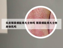 头皮银屑病能用凡士林吗 银屑病能用凡士林身体乳吗