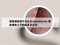银屑病皮肤干怎么办mbaiducom 银屑病身上干的起皮怎么办