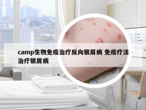 camp生物免疫治疗反向银屑病 免疫疗法治疗银屑病